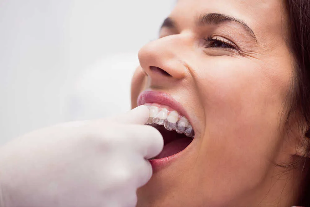 ortodontka zakłada Clear Aligner pacjentce